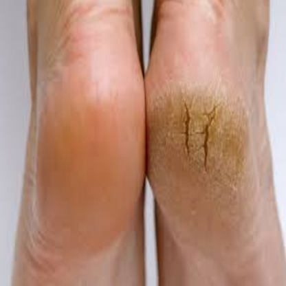 ComfortSole™ Callus Eraser